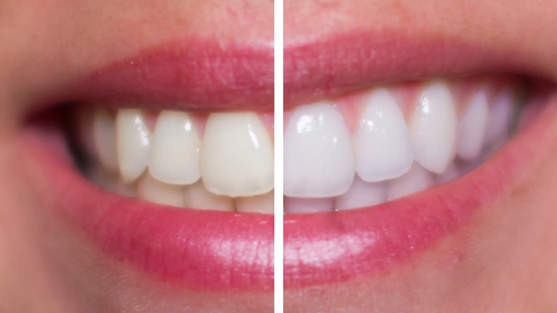 26218 teeth whitening cost