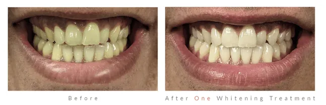 26221 teeth whitening light