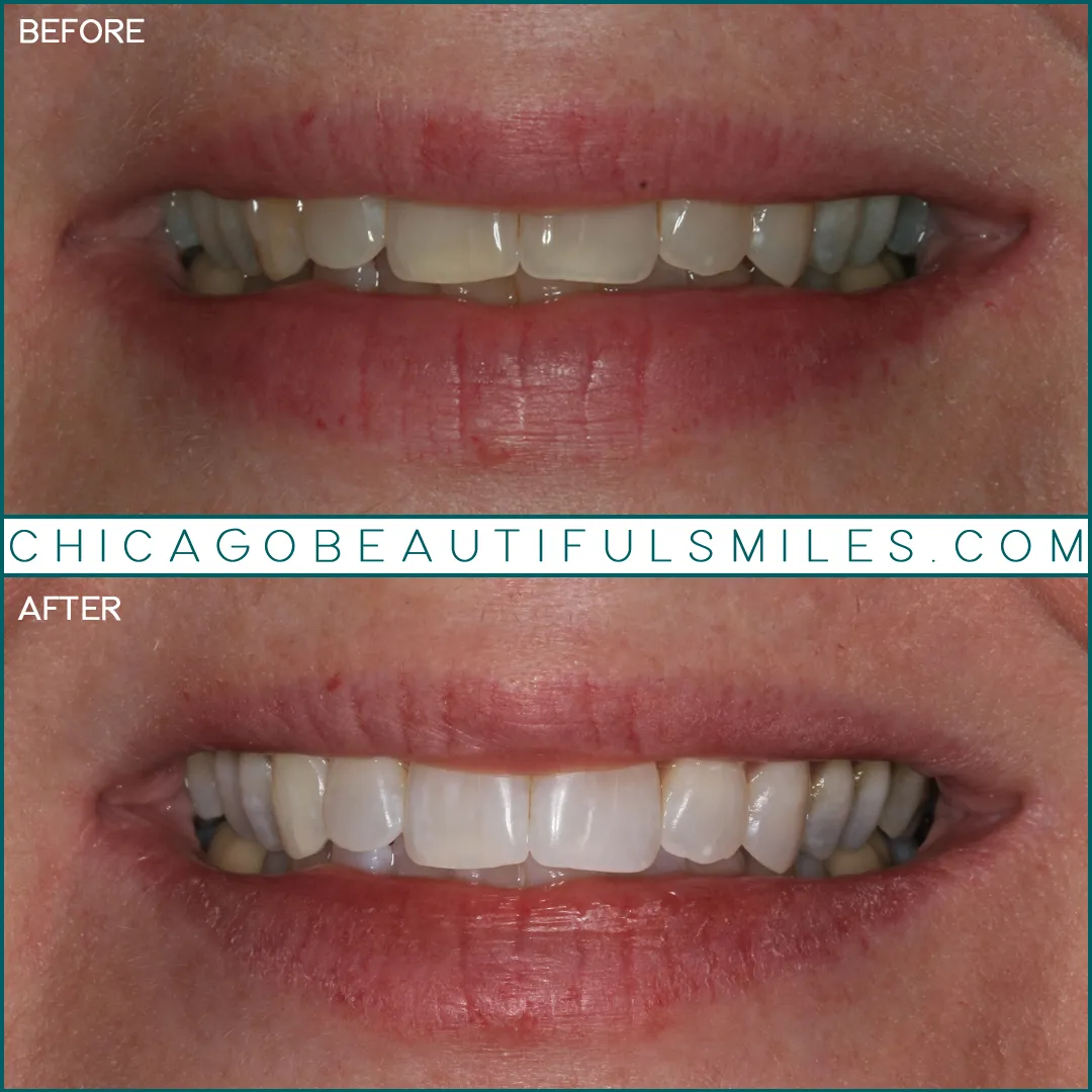 26224 uneven teeth whitening