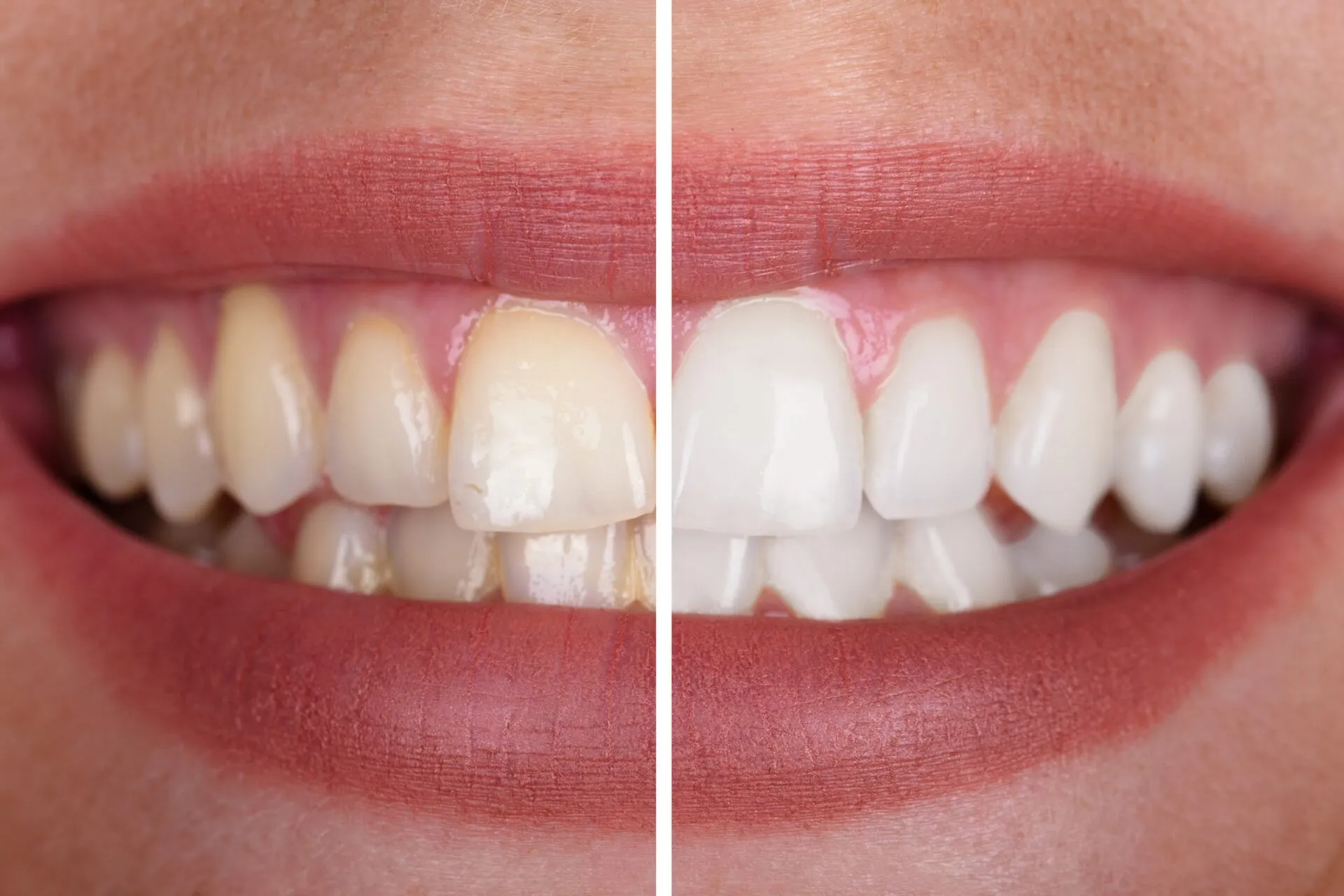 26235 teeth whitening wilmington nc 4