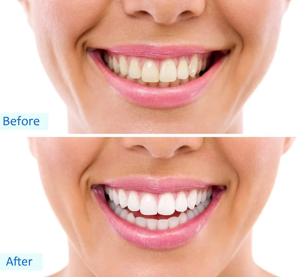 26238 teeth whitening procedure