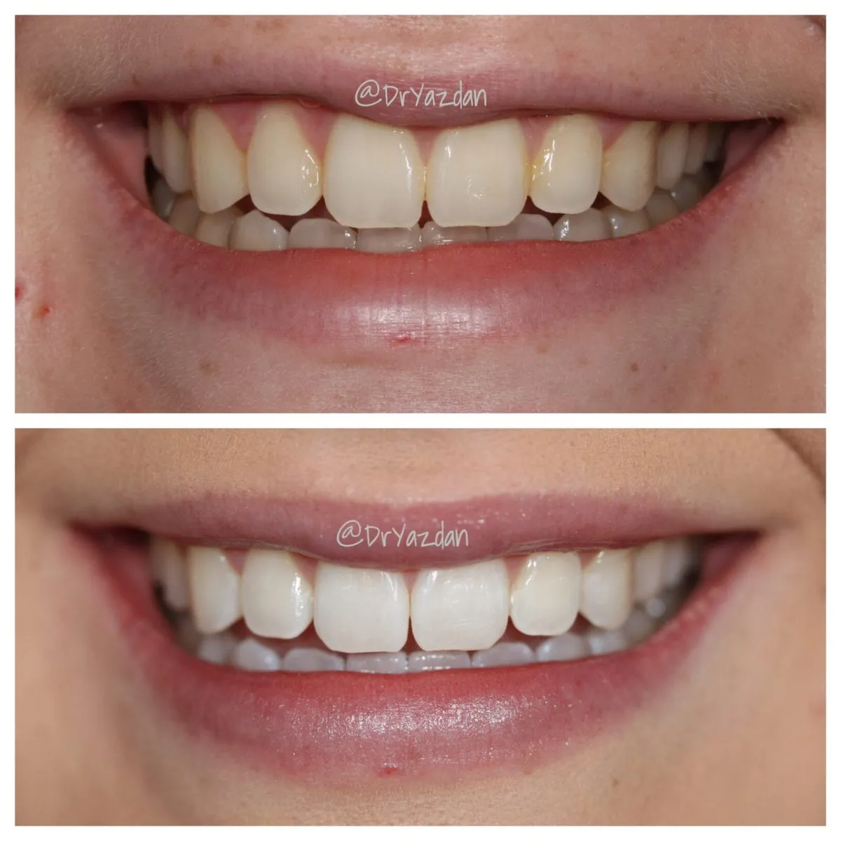 26240 teeth whitening dayre before after