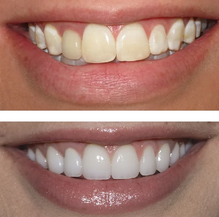 /img/26240-teeth-whitening-dayre-consultation.webp