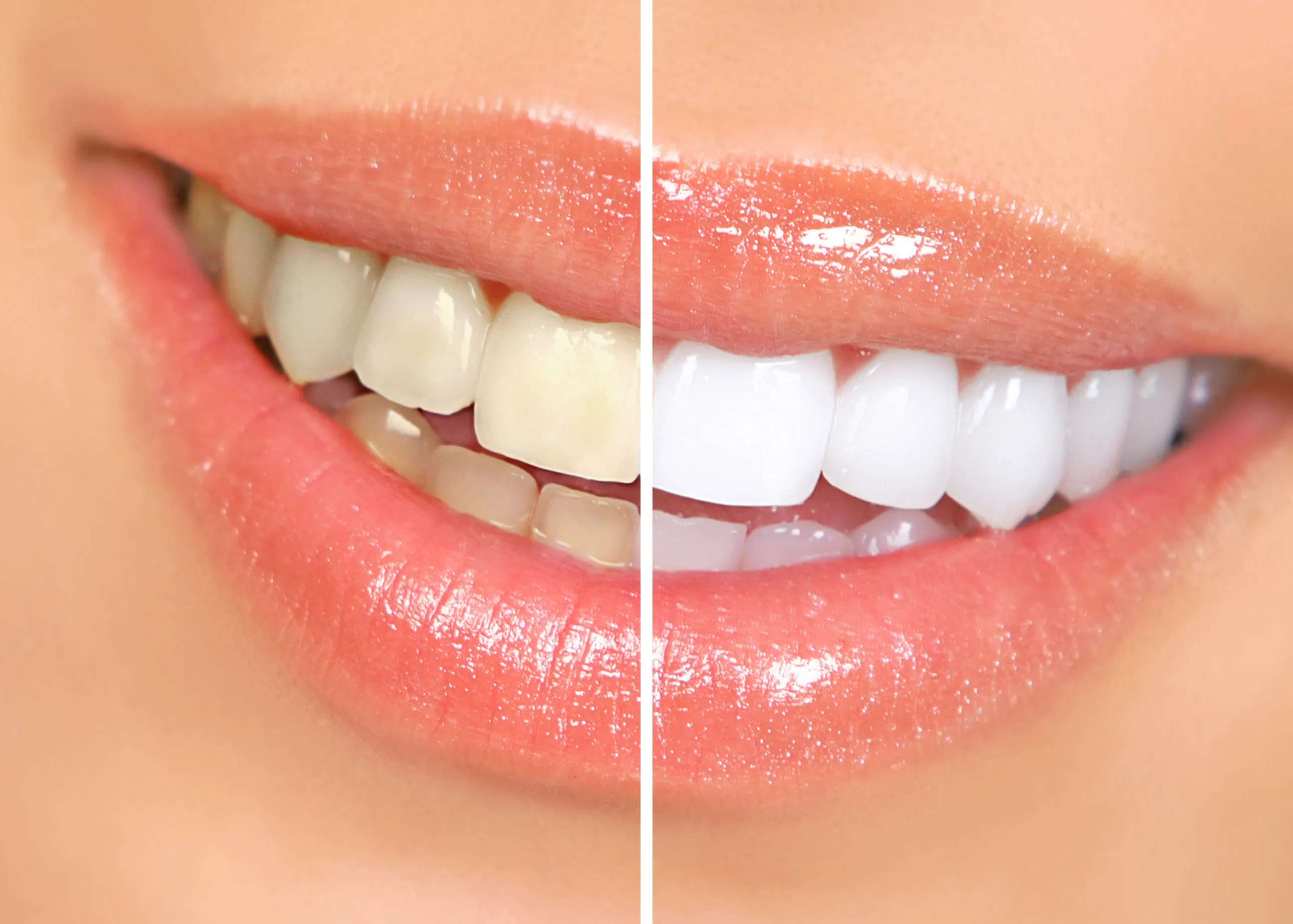 26240 teeth whitening risks