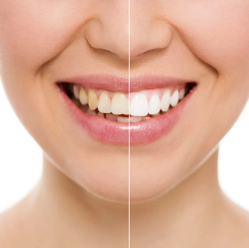 26241 professional teeth whitening