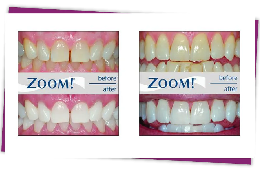 26244 teeth whitening before after
