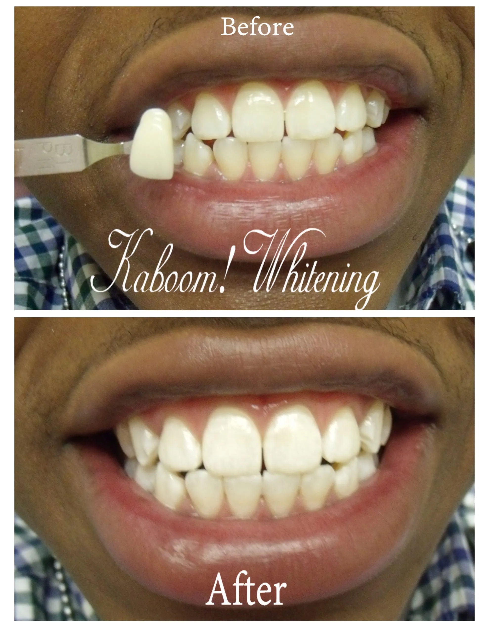 26247 over the counter whitening