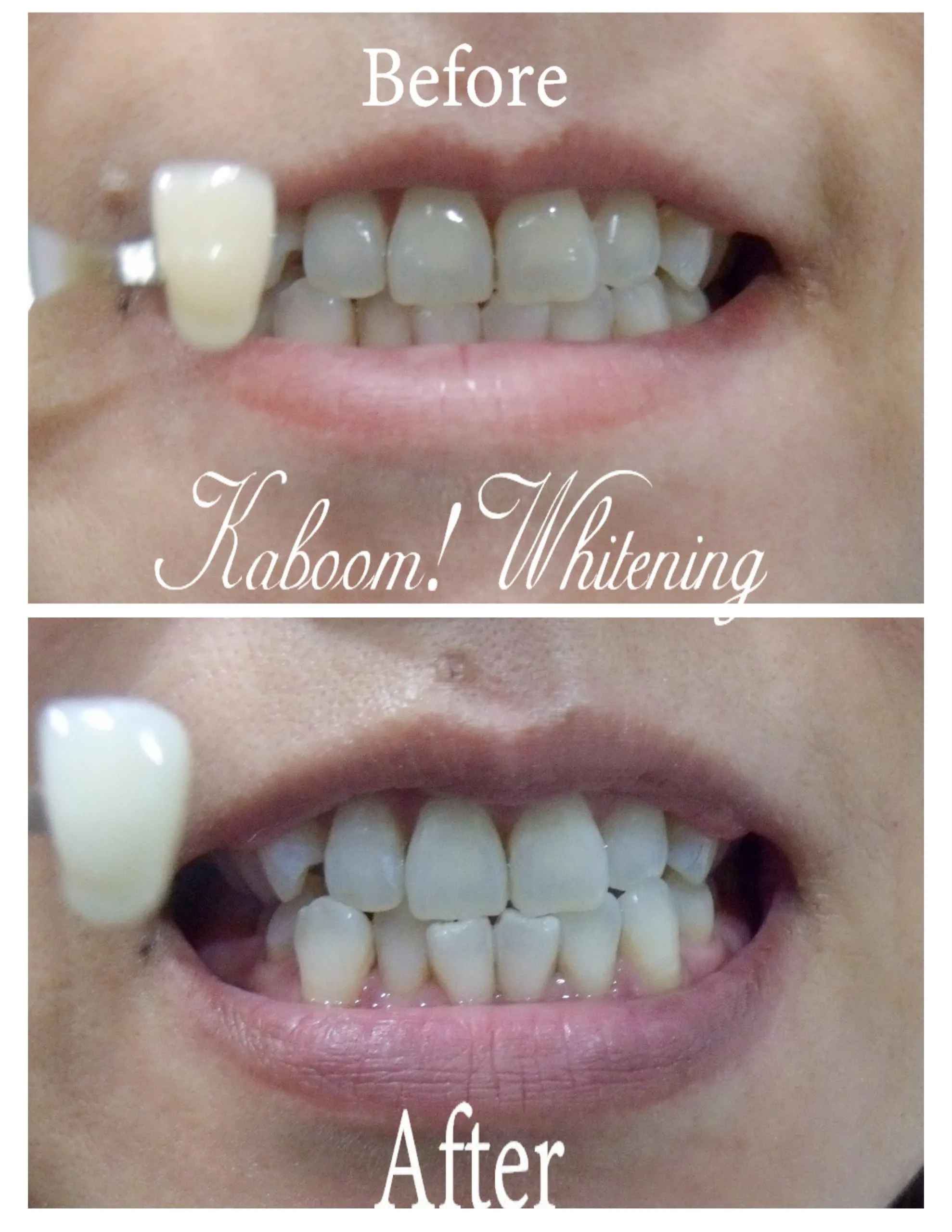 26247 take home whitening