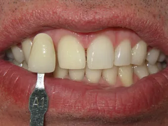 26257 teeth whitening raleigh nc intro