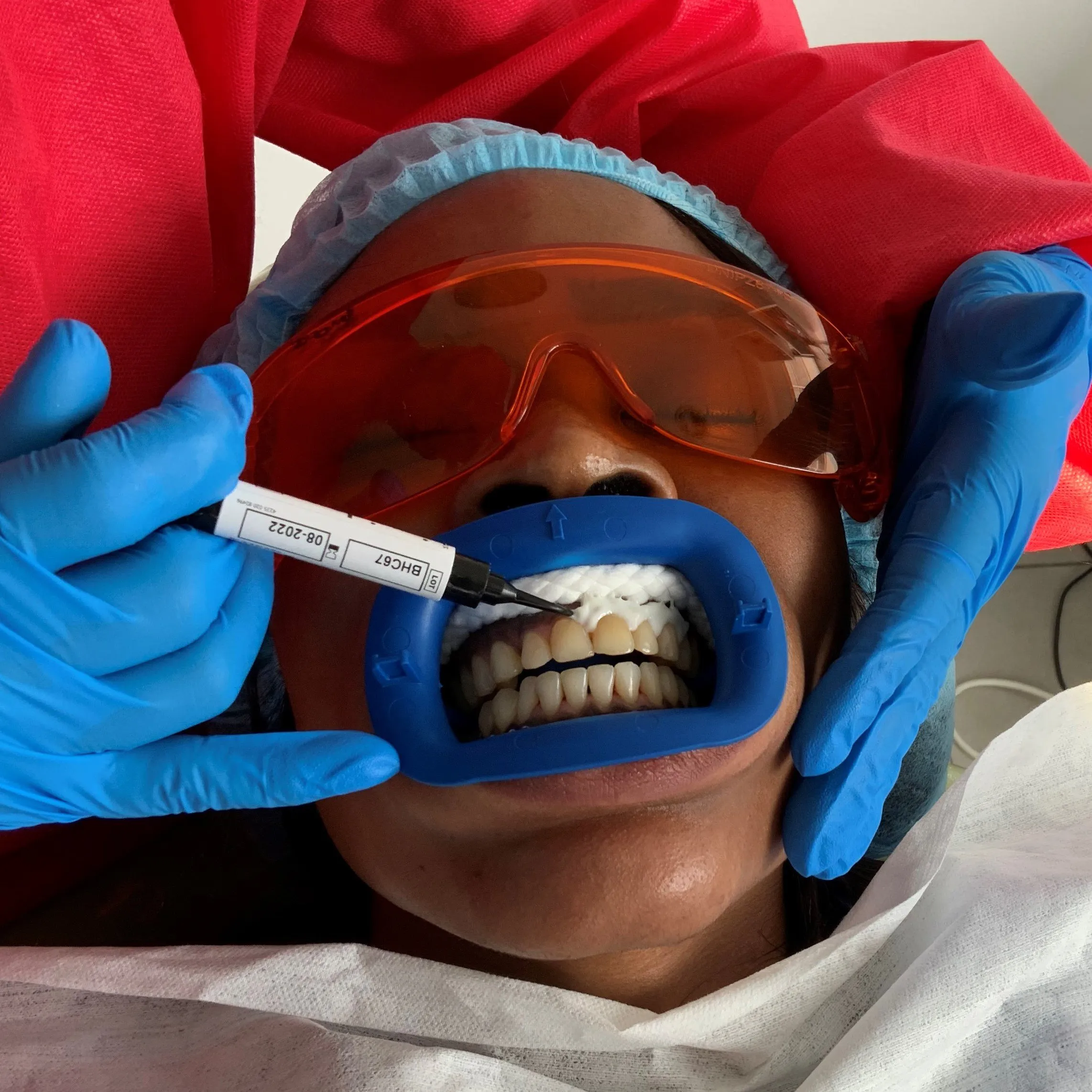 26261 in office teeth whitening