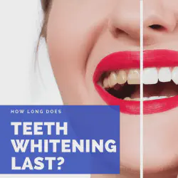 /img/26264-teeth-whitening-sensitivity.webp