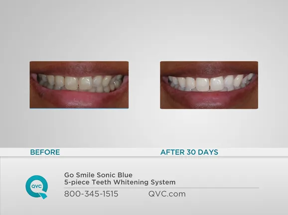 26267 sonic blue teeth whitening