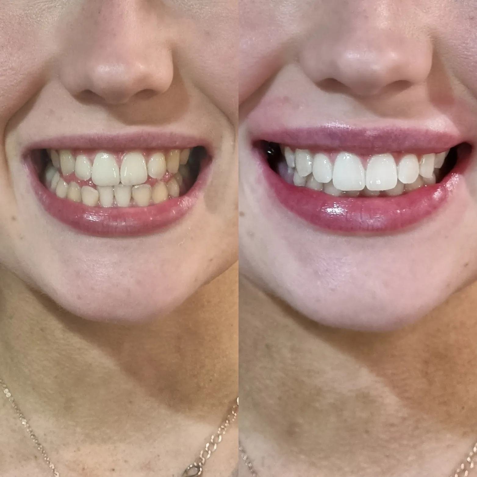 26271 teeth whitening melbourne 2