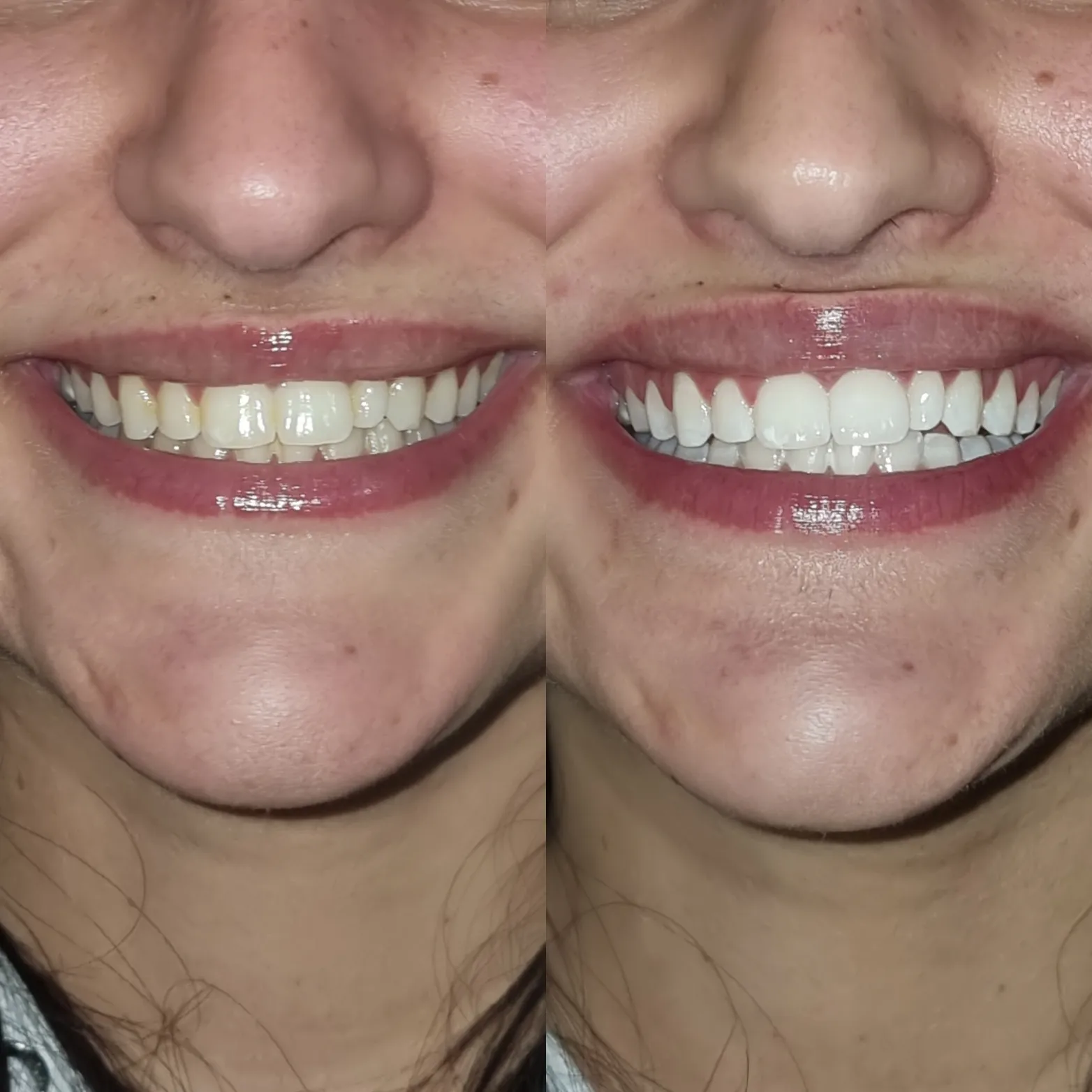 26271 teeth whitening melbourne 4