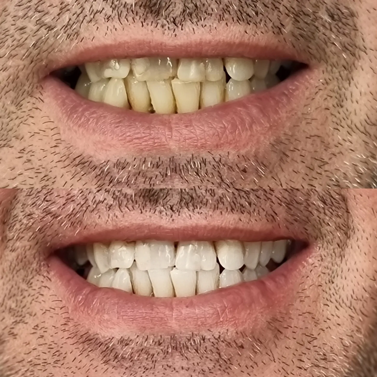 26271 teeth whitening melbourne 5