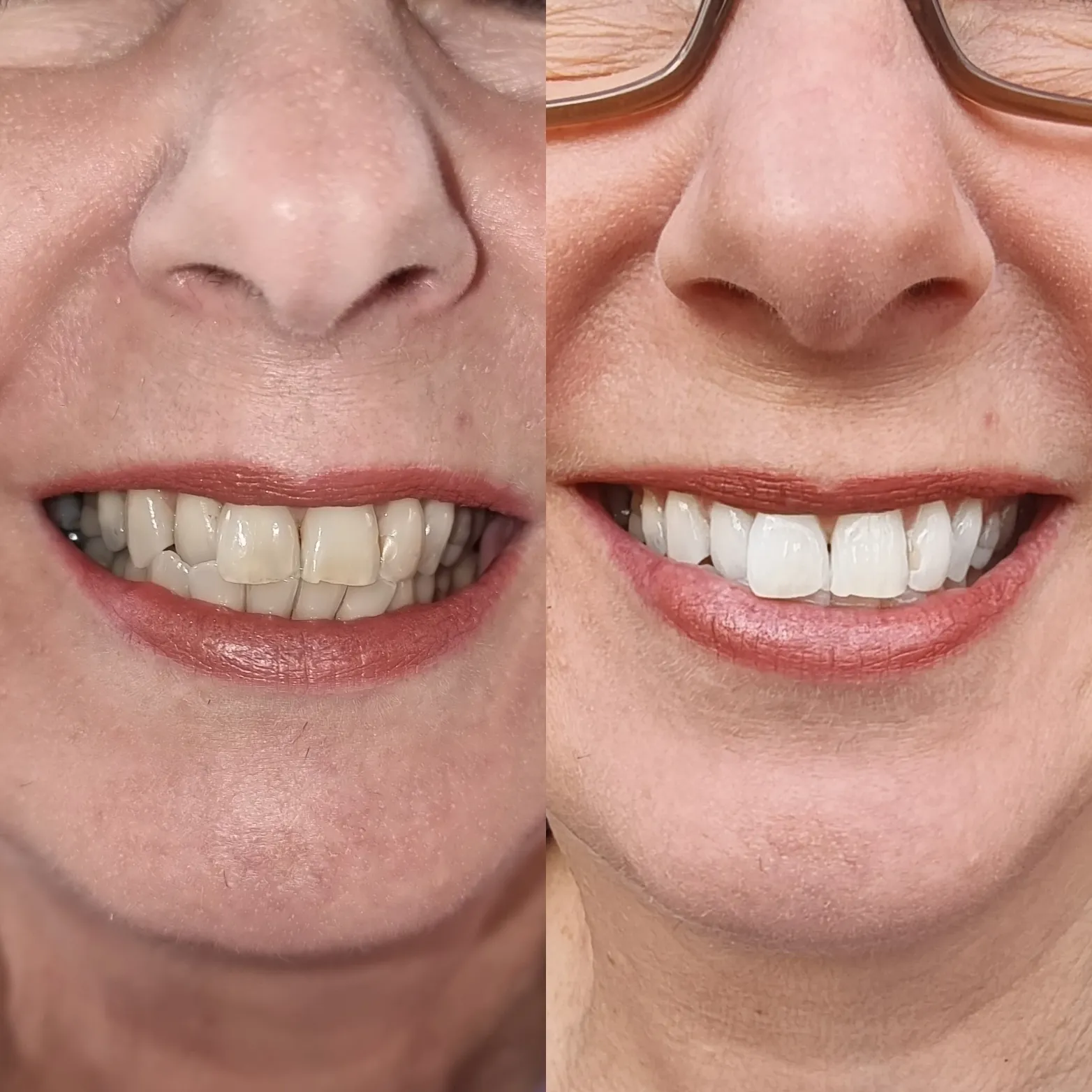 26271 teeth whitening melbourne 7