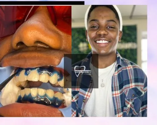 26283 take home teeth whitening kit