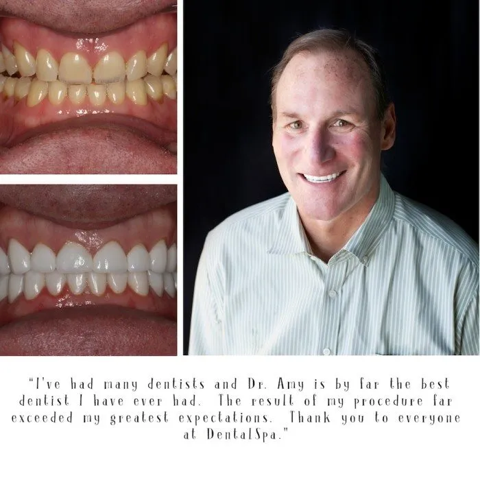 26283 teeth whitening indianapolis smile