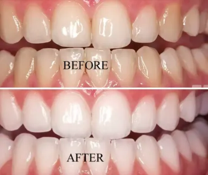 26290 teeth whitening peroxide uk image 1