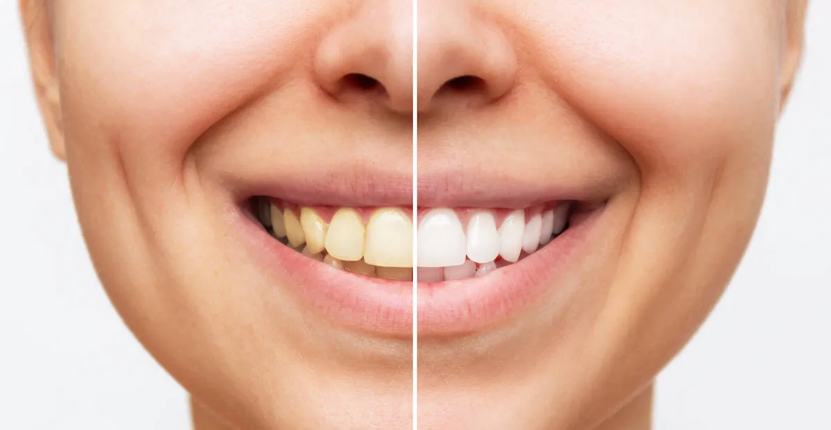 26297 teeth whitening process
