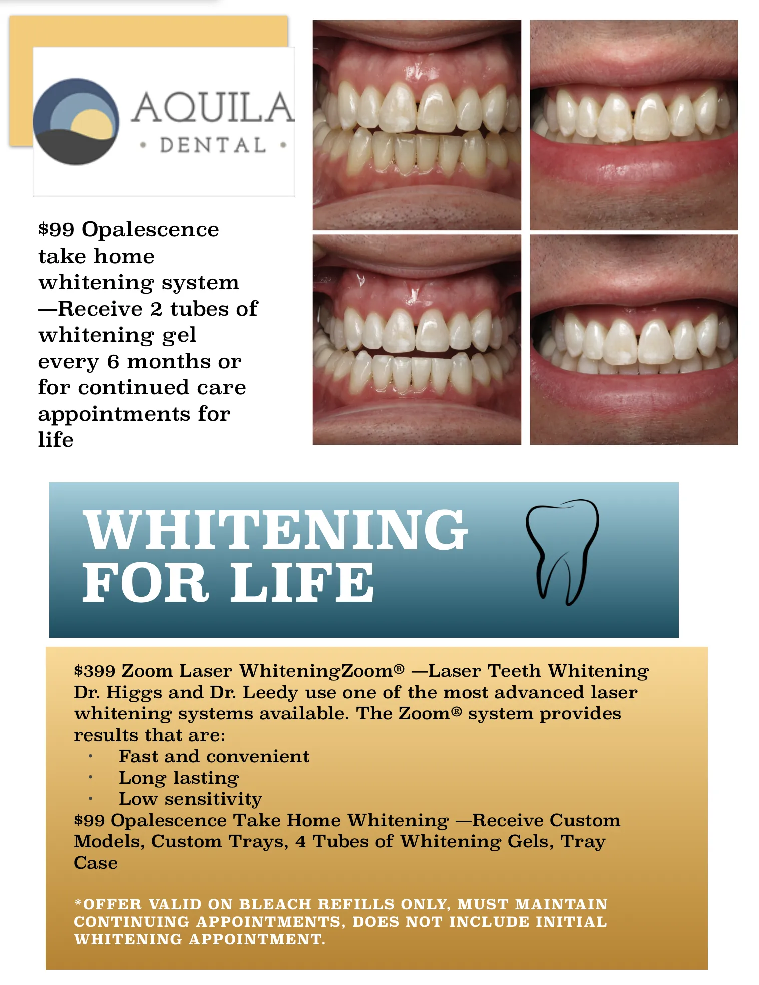 26298 teeth whitening results