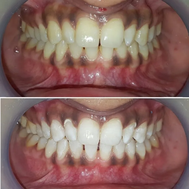 26305 laser teeth whitening overview