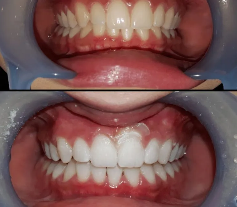 26305 laser teeth whitening procedure