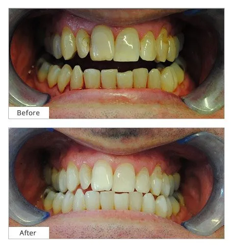 26305 laser teeth whitening results