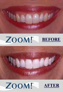 26306 teeth whitening alternatives