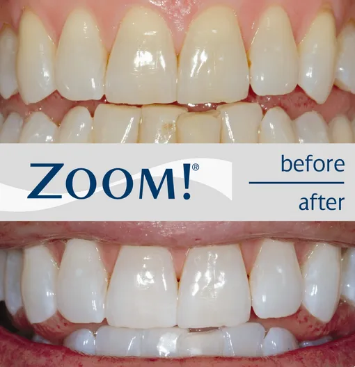 26315 geographic location teeth whitening