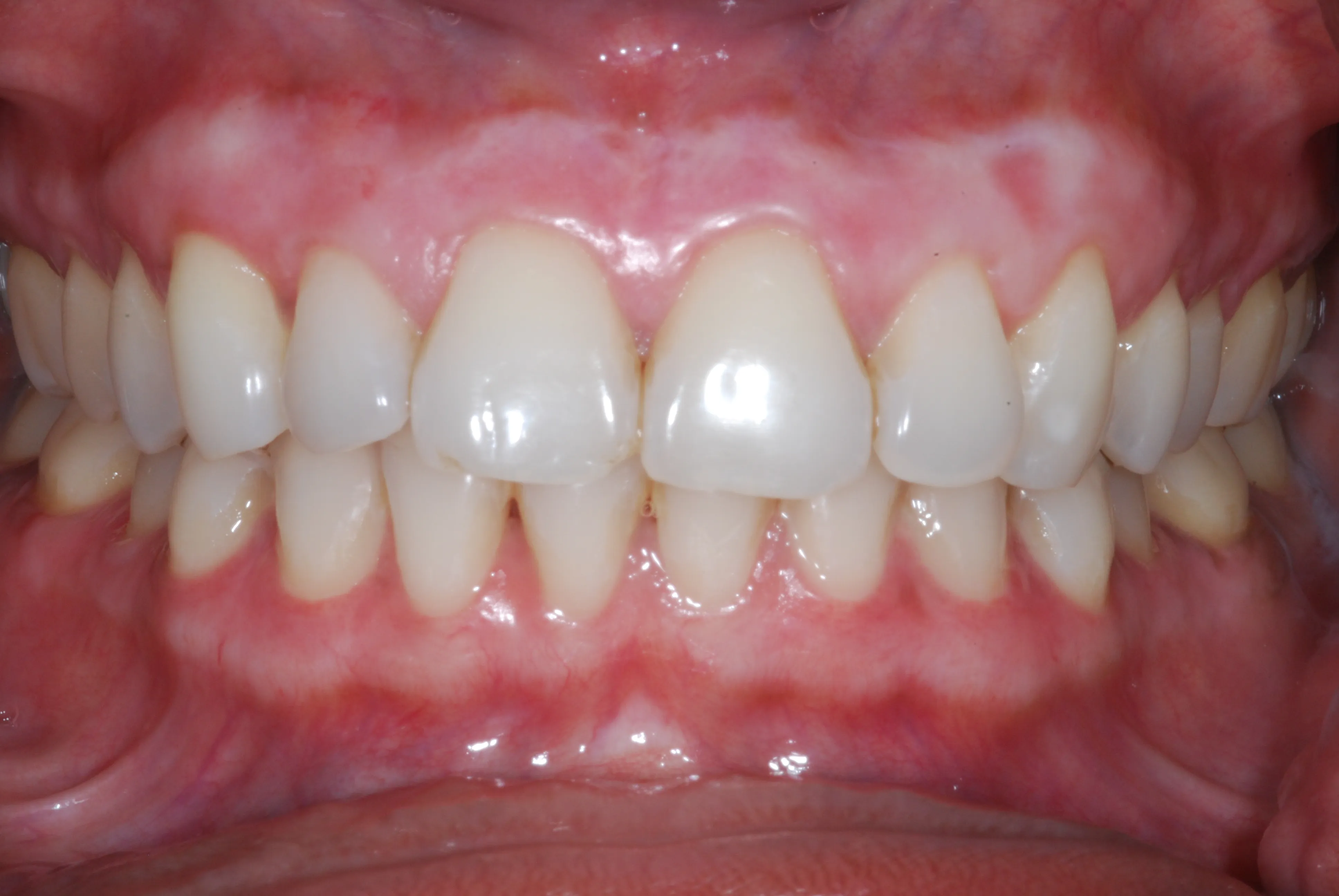 /img/26324-teeth-whitening-aftercare.webp