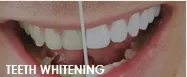 26341 teeth whitening fresno ca maintenance