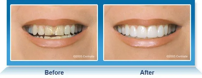 26341 teeth whitening fresno ca oral health