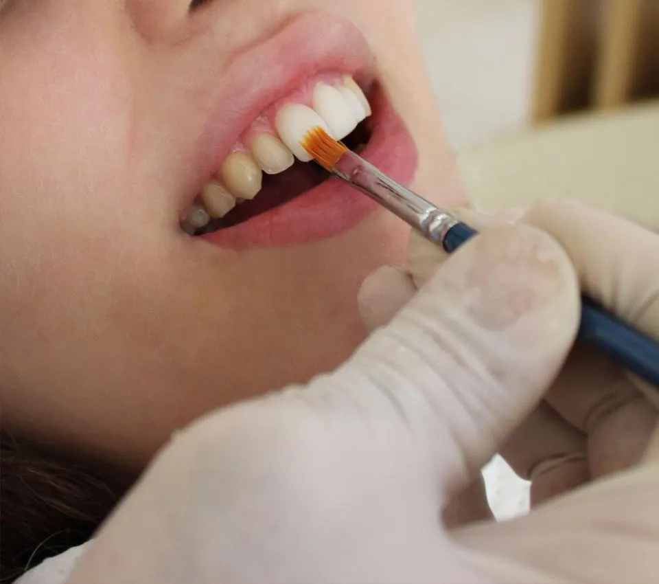 26343 veneers teeth whitening smile