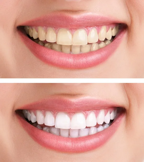 26353 teeth whitening oak lawn methods