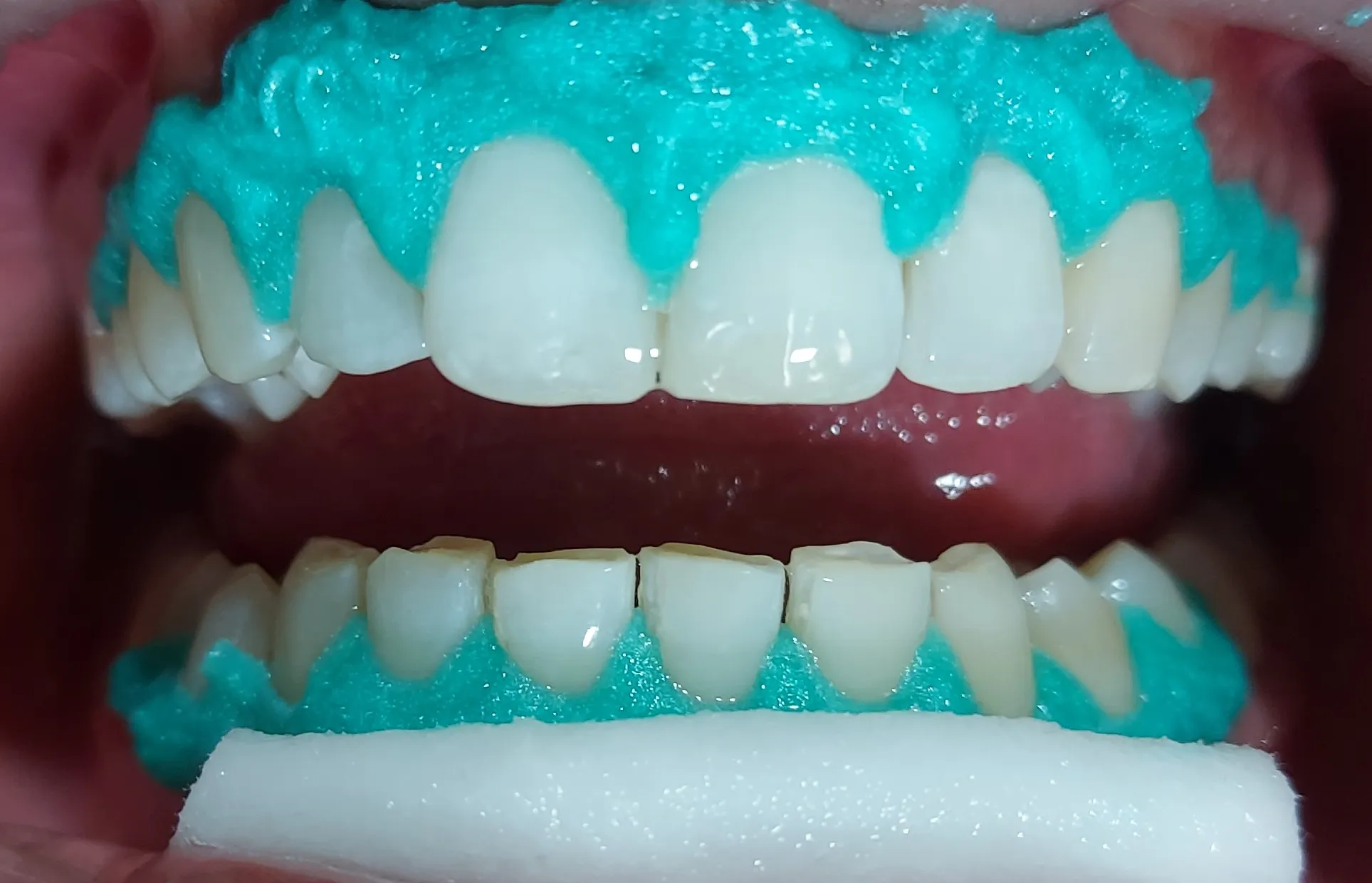 26353 teeth whitening oak lawn oral hygiene