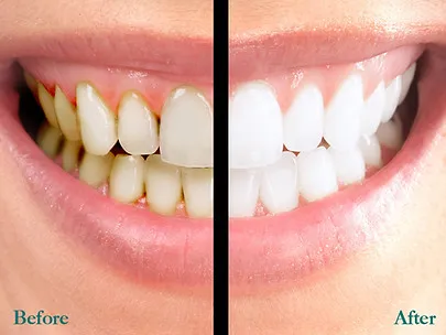 26353 teeth whitening oak lawn procedure