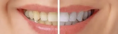 26354 at home teeth whitening