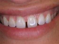 26356 professional teeth whitening