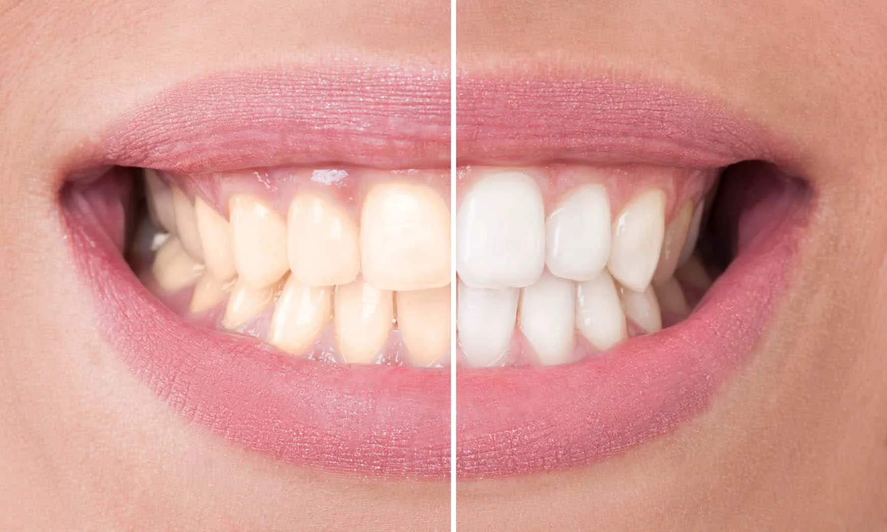 26365 teeth whitening eastern suburbs healthy gums