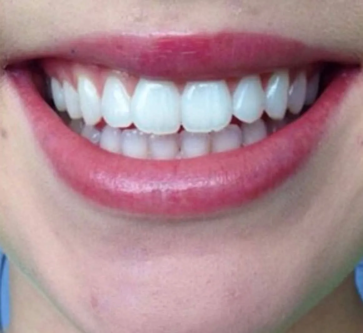 /img/26365-teeth-whitening-eastern-suburbs-products.webp