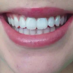 /img/26365-teeth-whitening-eastern-suburbs-products.webp