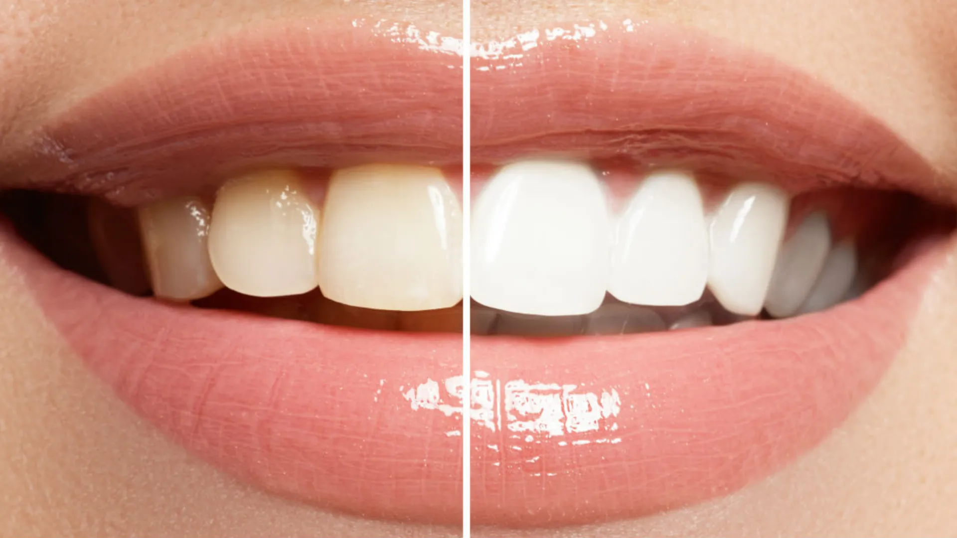26370 teeth whitening cost
