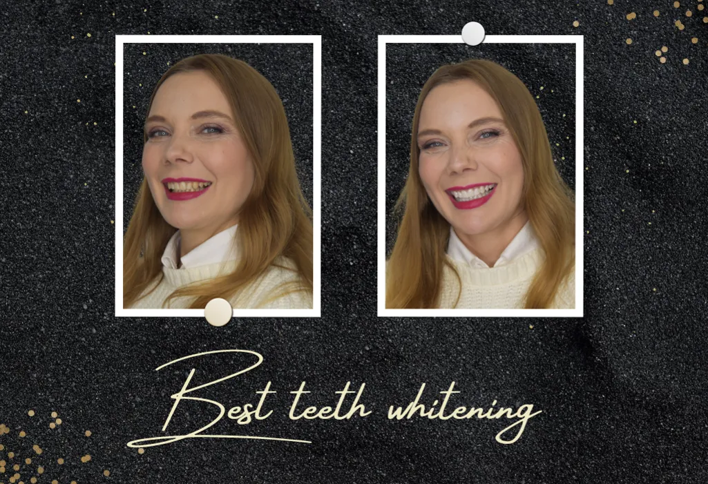 26375 laser teeth whitening