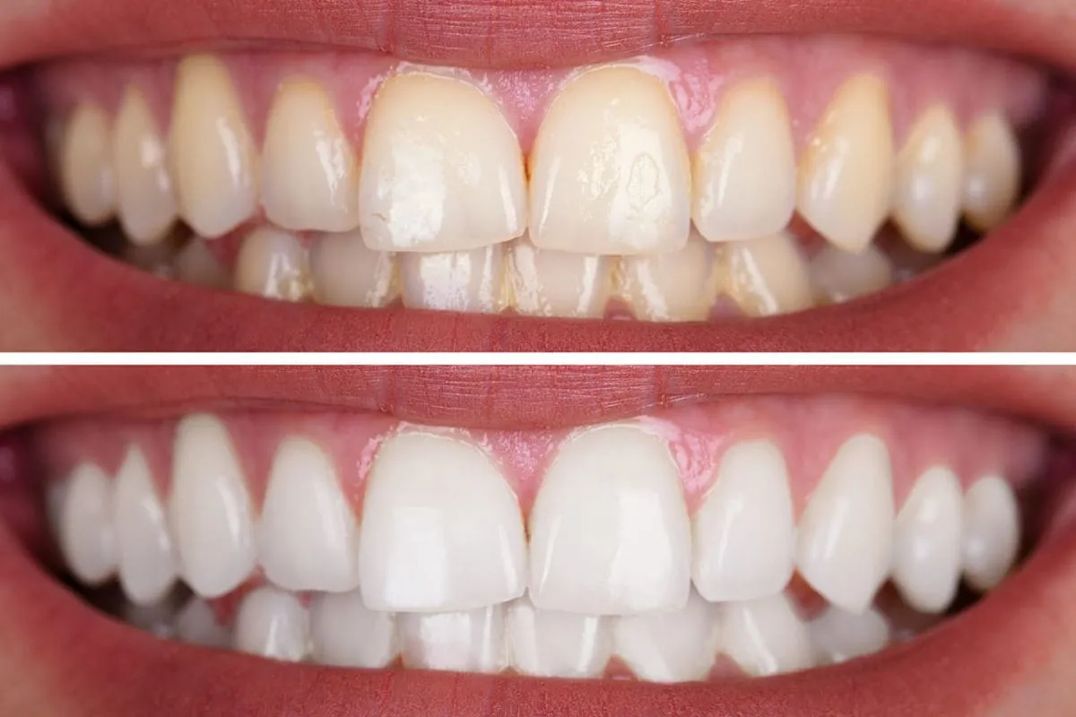 26386 teeth whitening procedure