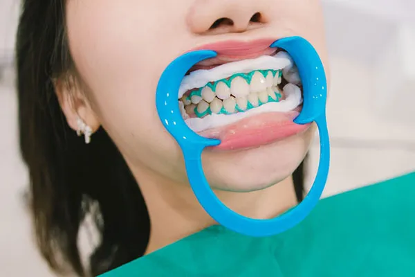 26390 newport beach dental cleaning