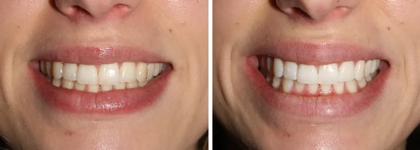 26390 newport beach teeth whitening before after