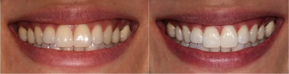 26390 teeth whitening newport beach dentist