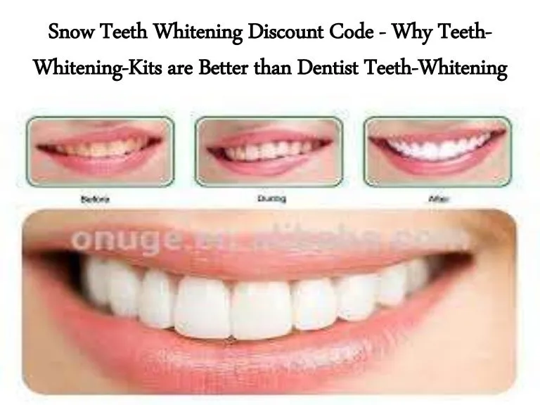 26392 ismile whitening kit