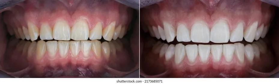 26393 at home teeth whitening kits